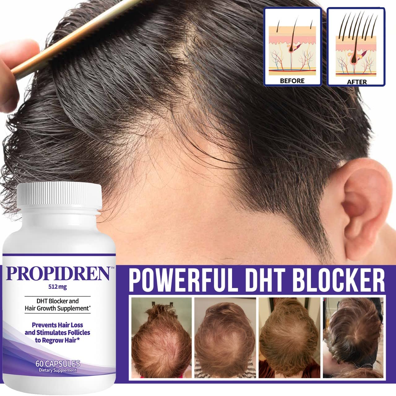 Propidren by HairGenics - DHT Blocker with Saw Palmetto To Prevent Hair Loss